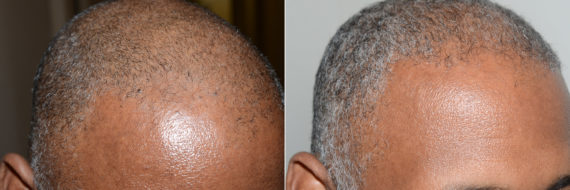 Trasplante de Pelo en Hombres Before and after in Miami, FL, Paciente 118937