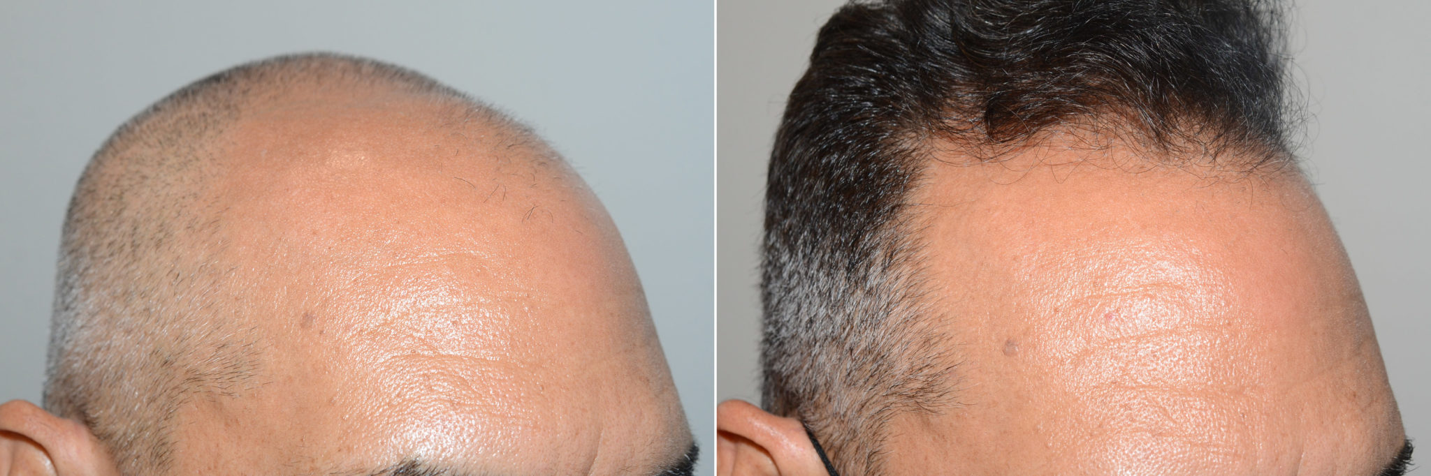 Hair Transplants For Men Photos Miami Fl Patient119235