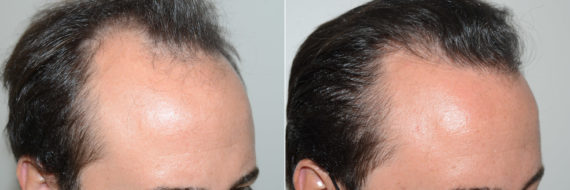 Trasplante de Pelo en Hombres Before and after in Miami, FL, Paciente 119339