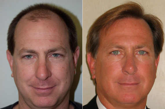 Hair Transplants for Men Before and after in Miami, FL, Paciente 37729