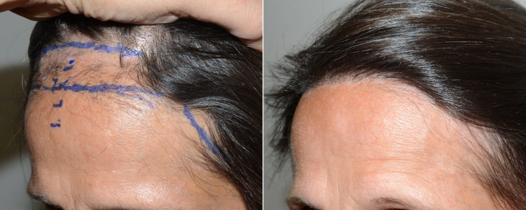 Forehead Reduction Surgery, Reparative Hair Transplant Photos | Miami ...