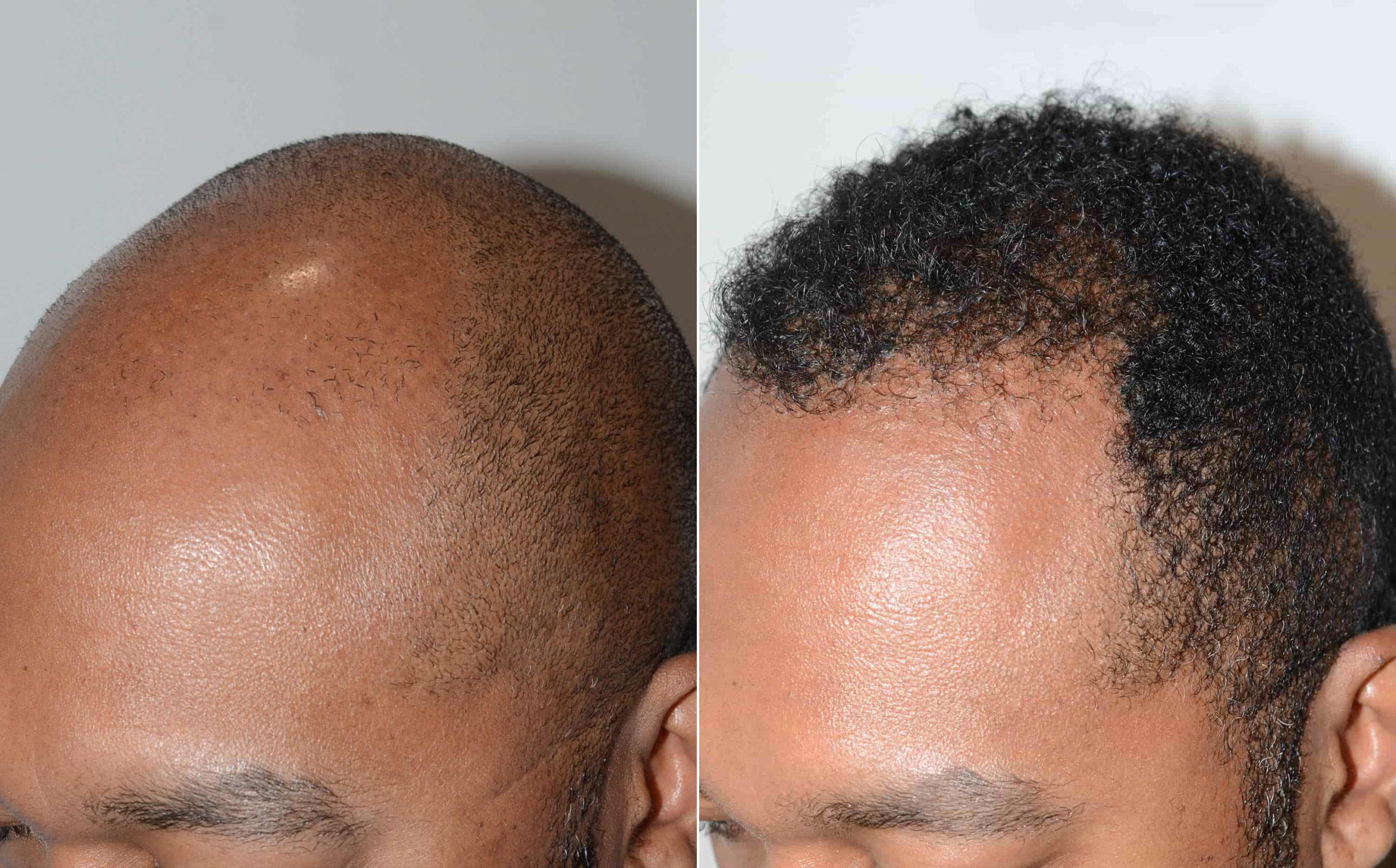FUE Hair Transplants - This Is What Real Life Results Look Like