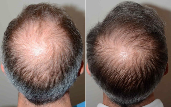 Hair Transplants for Men Before and after in Miami, FL, Paciente 120543