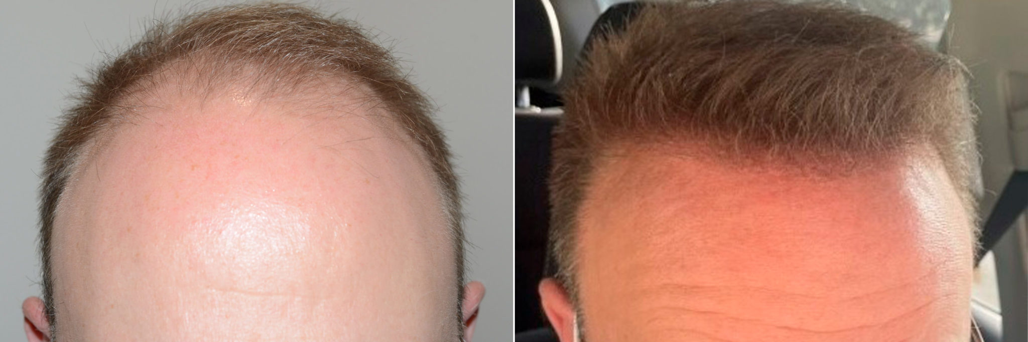 Hair Transplants For Men Photos Miami Fl Patient120566