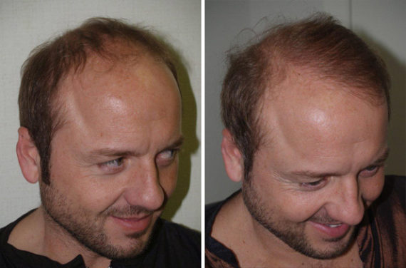 Trasplante de Pelo en Hombres Before and after in Miami, FL, Paciente 77192