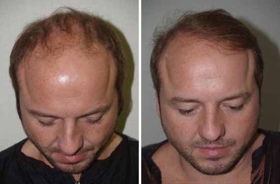 Trasplante de Pelo en Hombres Before and after in Miami, FL, Paciente 77192