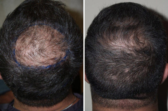 Trasplante de Pelo en Hombres Before and after in Miami, FL, Paciente 88772