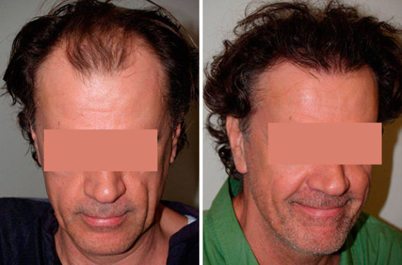 Trasplante de Pelo en Hombres Before and after in Miami, FL, Paciente 90015