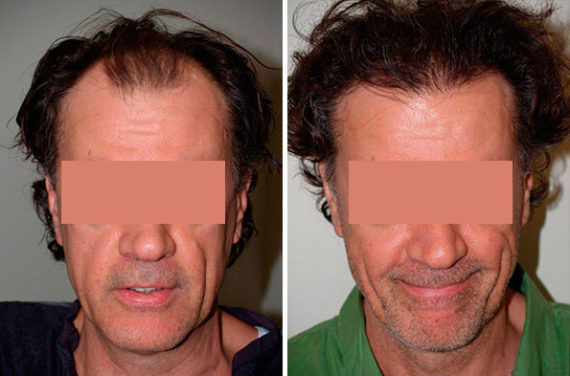 Trasplante de Pelo en Hombres Before and after in Miami, FL, Paciente 90015