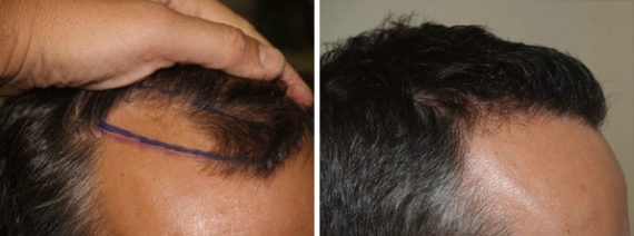 Trasplante de Pelo en Hombres Before and after in Miami, FL, Paciente 90187