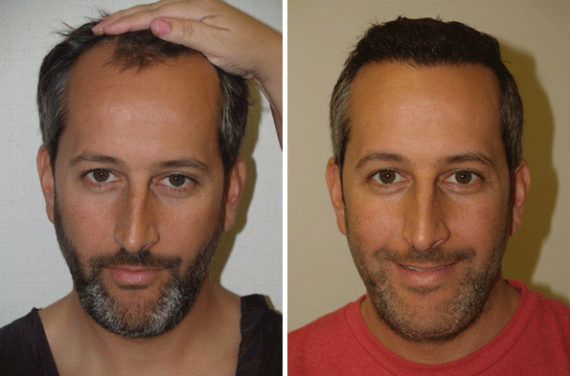 Trasplante de Pelo en Hombres Before and after in Miami, FL, Paciente 90187