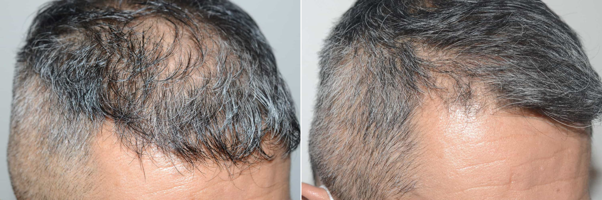 Hair Transplants For Men Photos Miami Fl Patient121062