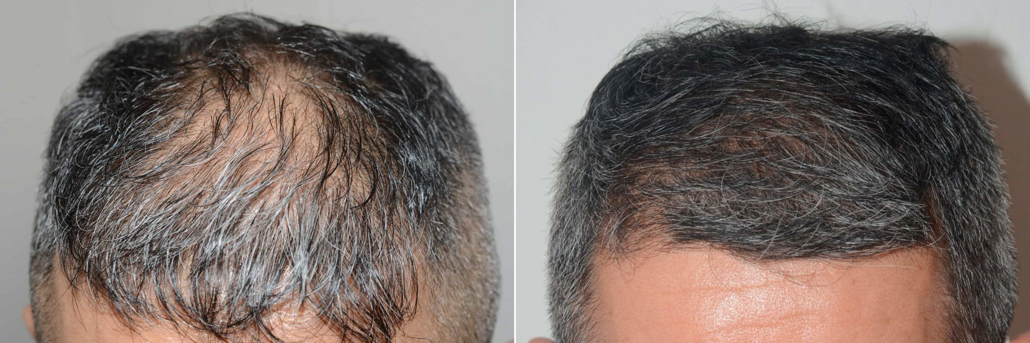 Hair Transplants for Men before and after photos - Foundation For Hair ...