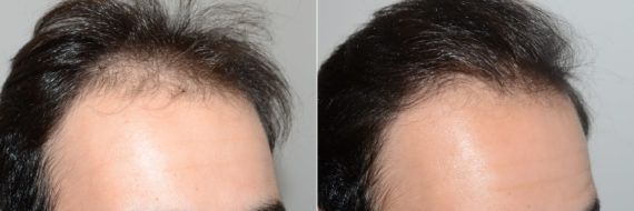 Trasplante de Pelo en Hombres Before and after in Miami, FL, Paciente 119340