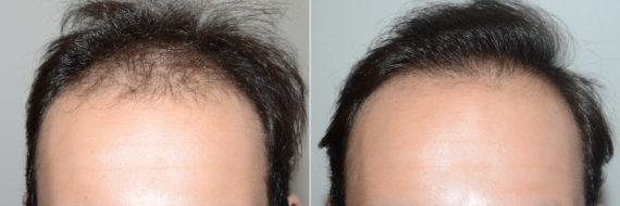 Trasplante de Pelo en Hombres Before and after in Miami, FL, Paciente 119340