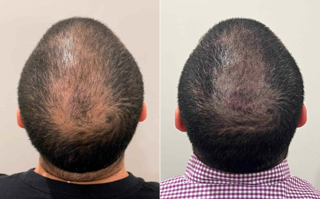 Scalp Micropigmentation photos | Miami, FL | Patient121705