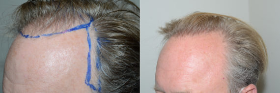 Hair Transplants for Men Before and after in Miami, FL, Paciente 123149