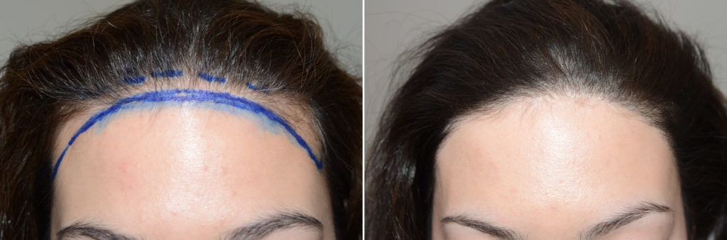 Forehead Reduction Surgery, Hair Transplants For Women Photos | Miami ...