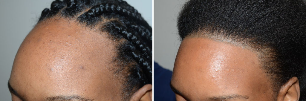 Forehead Reduction Surgery photos | Miami, FL | Patient123808