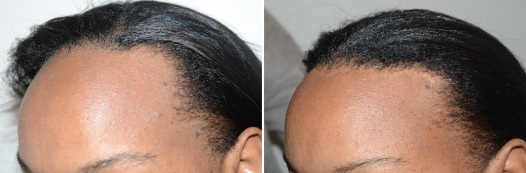 Forehead Reduction Surgery photos | Miami, FL | Patient123827