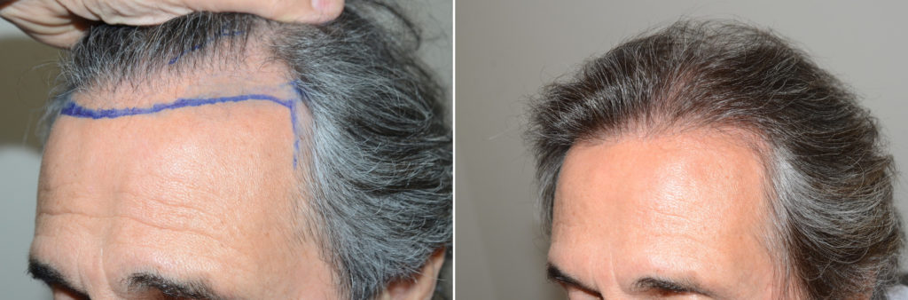 Hair Transplants For Men Photos Miami Fl Patient123951