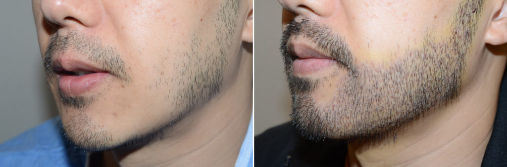 Facial Hair Transplant photos | Miami, FL | Patient124075