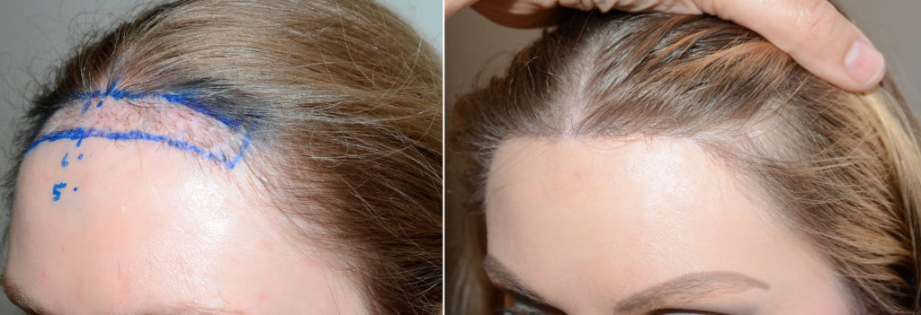 Forehead Reduction Surgery Before And After Photos Foundation For Hair Restoration