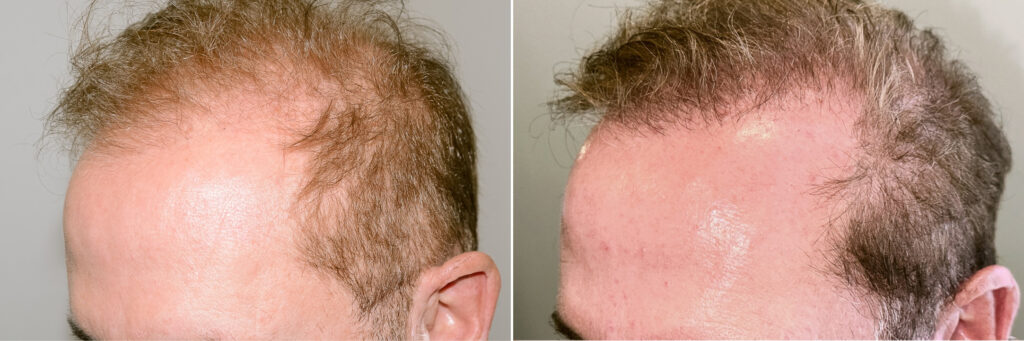 Body Hair Transplant Hair Transplants For Men Reparative Hair