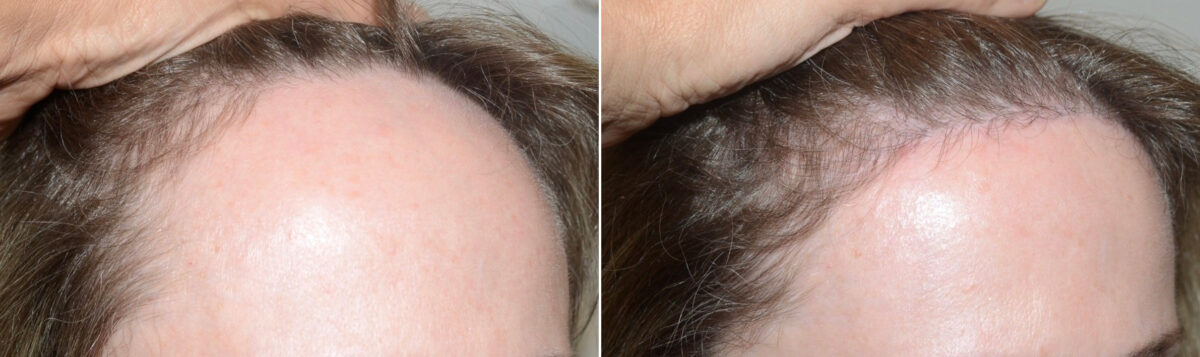 Forehead Reduction Surgery Before and after in Miami, FL, Paciente 124414