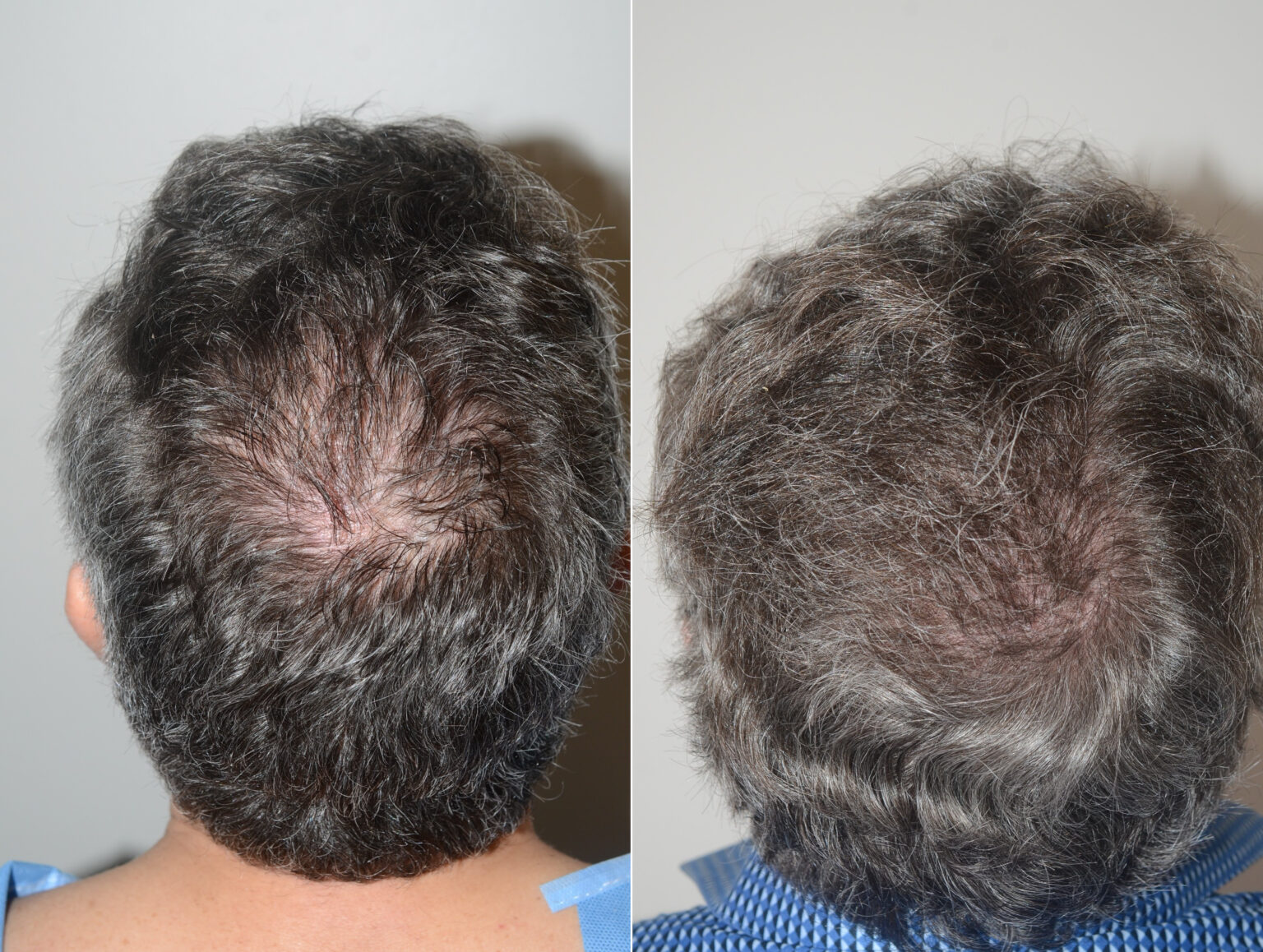 Body Hair Transplant Before And After Photos Foundation For Hair