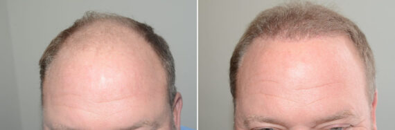 Hair Transplants for Men Before and after in Miami, FL, Paciente 123581