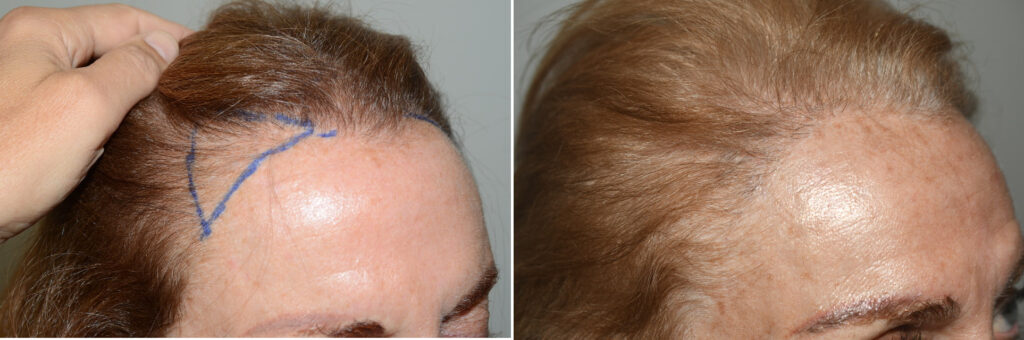 Forehead Reduction Surgery, Hair Transplants For Women Photos | Miami ...