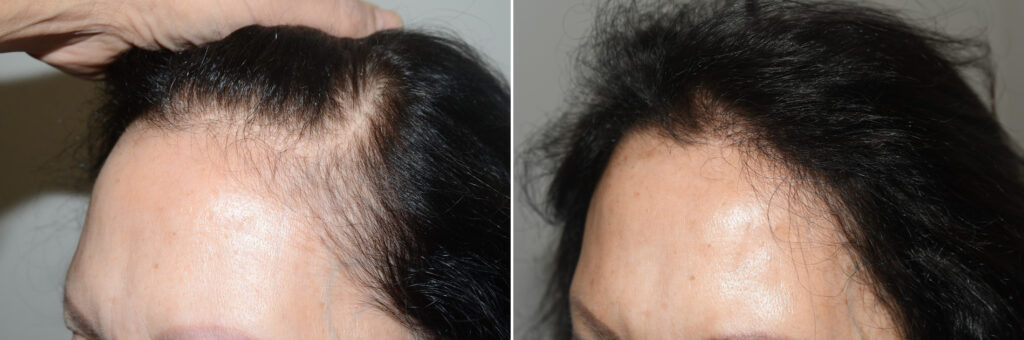 Forehead Reduction Surgery, Hair Transplants for Women photos | Miami ...