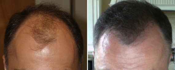 Hair Transplants for Men Before and after in Miami, FL, Paciente 37618