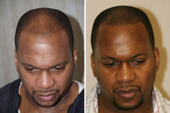 Hair Transplants for Men Before and after in Miami, FL, Paciente 37710