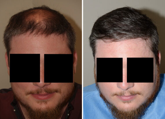 Hair Transplants for Men Before and after in Miami, FL, Paciente 37776