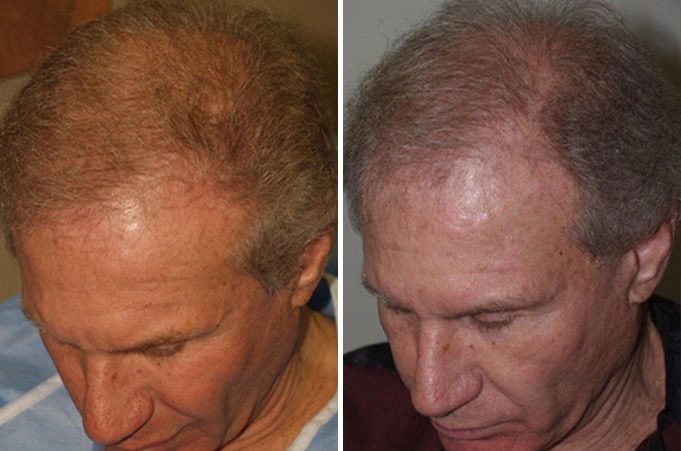 Body Hair Transplant Before And After Photos Foundation For Hair