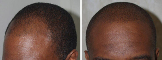 Hair Transplants for Men Before and after in Miami, FL, Paciente 37972