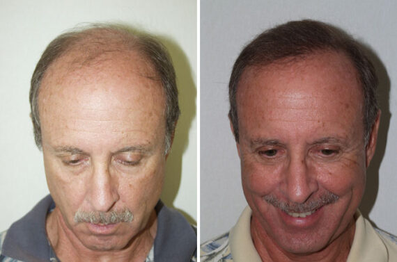 Hair Transplants for Men Before and after in Miami, FL, Paciente 38661