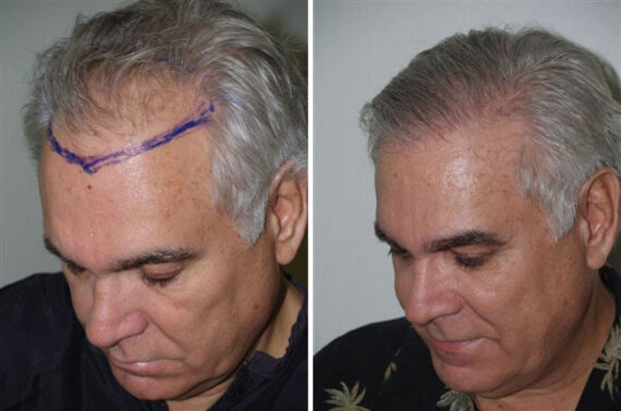 Hair Transplants for Men Before and after in Miami, FL, Paciente 38975