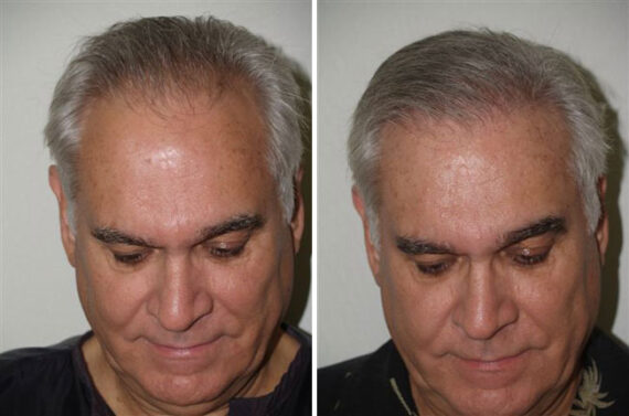 Hair Transplants for Men Before and after in Miami, FL, Paciente 38975