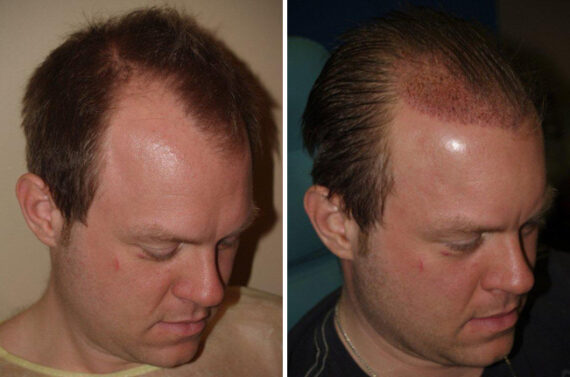 Hair Transplants for Men Before and after in Miami, FL, Paciente 39021