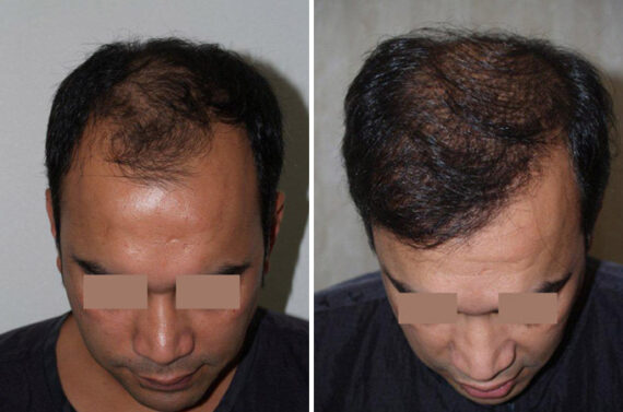 Hair Transplants for Men Before and after in Miami, FL, Paciente 39282