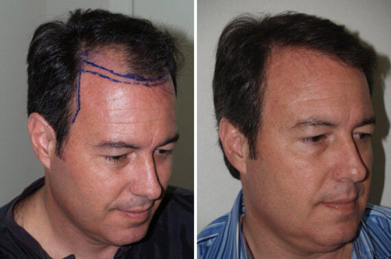 Hair Transplants for Men Before and after in Miami, FL, Paciente 39700