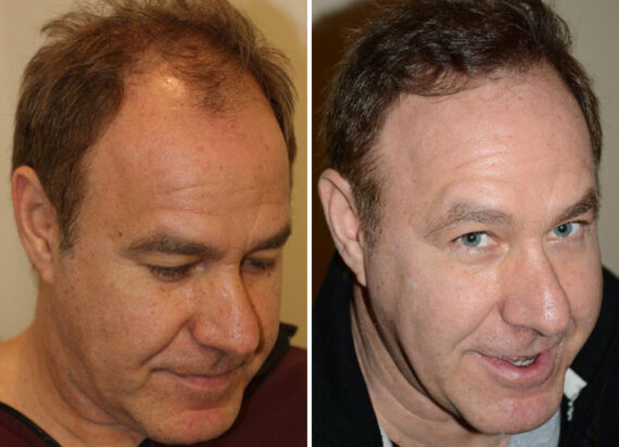 Hair Transplants for Men Before and after in Miami, FL, Paciente 40095