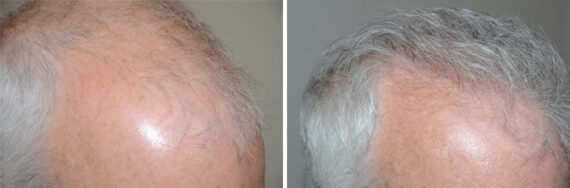 Hair Transplants for Men Before and after in Miami, FL, Paciente 40106