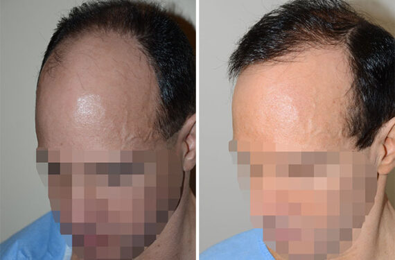 Hair Transplants for Men Before and after in Miami, FL, Paciente 40144