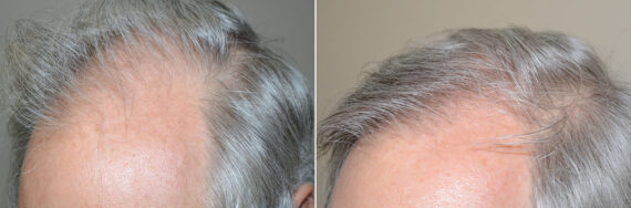 Hair Transplants for Men Before and after in Miami, FL, Paciente 57979