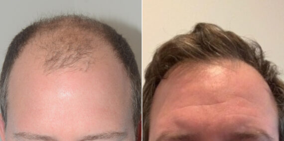 Hair Transplants for Men Before and after in Miami, FL, Paciente 58925