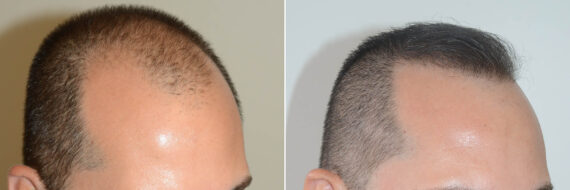 Hair Transplants for Men Before and after in Miami, FL, Paciente 59634